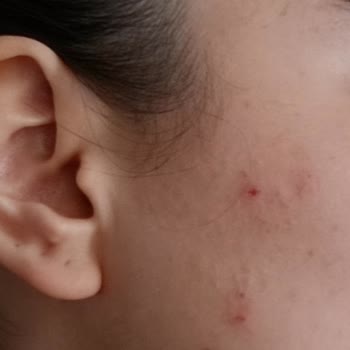 Cerave Cleanser Caused Breakouts – Refund Request Denied