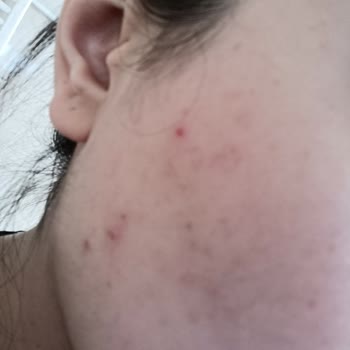 Cerave Cleanser Caused Breakouts – Refund Request Denied