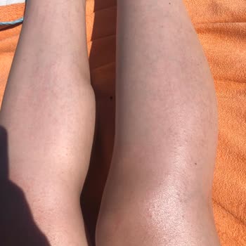 Gillette Venus Comfortglide Breeze Razor Caused Redness and Irritation