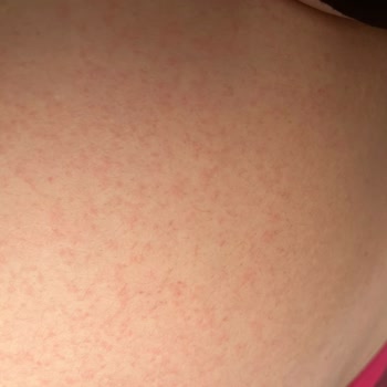 Mustela Krem: Kaşıntı Ve Kızarıklık Kabusu