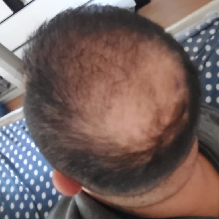 Estem Hair Clinic Saç Ekimi Yapılmadı!