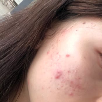 Bioderma Atoderm Kullanımı Sonrası Cilt Sorunları