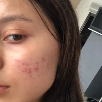 Bioderma Atoderm Kullanımı Sonrası Cilt Sorunları