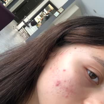 Bioderma Atoderm Kullanımı Sonrası Cilt Sorunları