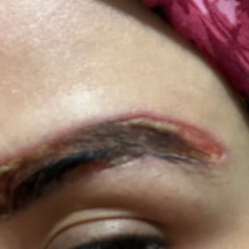 Kaş Sildirme İşlemi Sonrası Kimyasal Yanık Ve Enfeksiyon