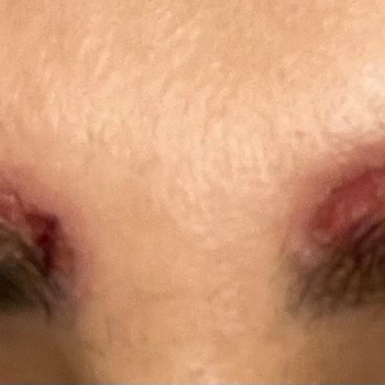 Kaş Sildirme İşlemi Sonrası Kimyasal Yanık Ve Enfeksiyon