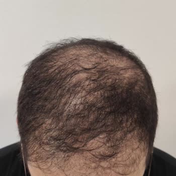 Saç Ekimi Hüsranı: Estethica Deneyimim