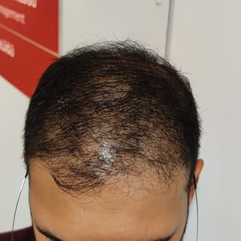 Saç Ekimi Hüsranı: Estethica Deneyimim