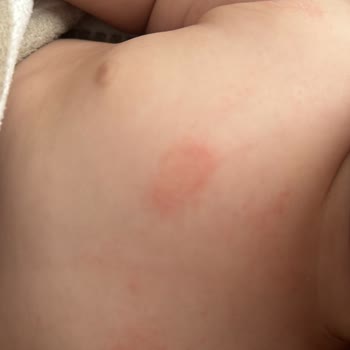 Bebeğimin Cildinde Kabaran Kırmızı Kabarcıklar