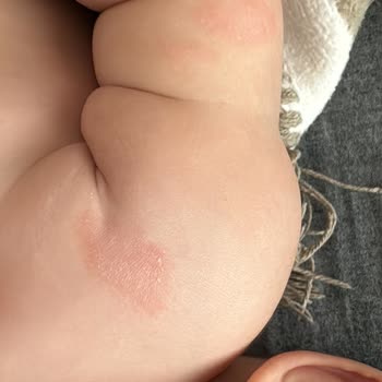 Bebeğimin Cildinde Kabaran Kırmızı Kabarcıklar