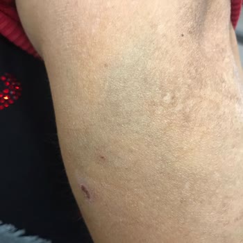 Hastanede Yanlış Damar Yolu Açma Sorunu