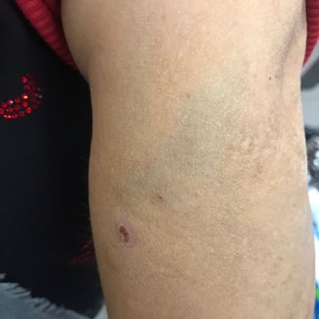 Hastanede Yanlış Damar Yolu Açma Sorunu