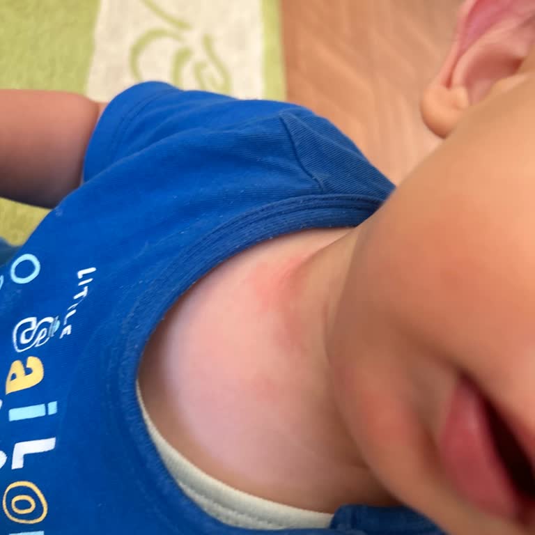 Hipp 2 Babynahrung Allergische Reaktion bei meinem Kind nach dem Trinken