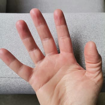 Fairy Dish Soap Severely Damaged My Hands