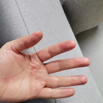 Fairy Dish Soap Severely Damaged My Hands