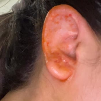 Başarısız Otoplasti Ameliyatı Ve İlgisizlik