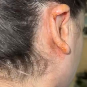 Başarısız Otoplasti Ameliyatı Ve İlgisizlik