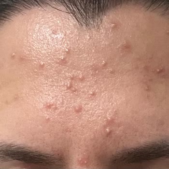 MM12 Kullanımı Sonrası Beklenmedik Cilt Sorunu