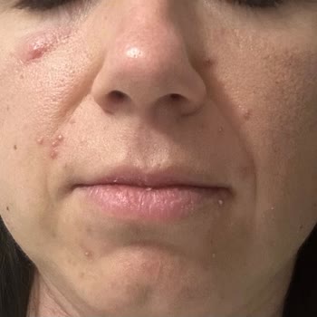 MM12 Kullanımı Sonrası Beklenmedik Cilt Sorunu