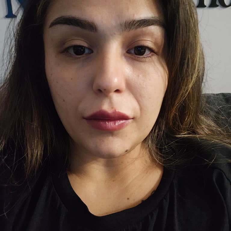 Dr. Kosmetoloq Aina Başarısız Dudak Dolgusu İşlemi!