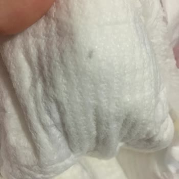 Bebek Bezinde Güven Sarsan Siyah Nokta Sorunu