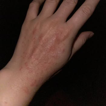 Persil Powder Detergent Caused Severe Itching and Skin Reactions