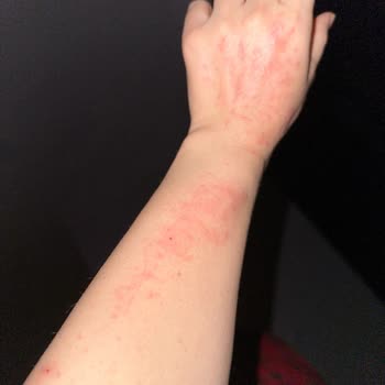 Persil Powder Detergent Caused Severe Itching and Skin Reactions