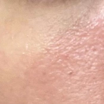 Severe Irritation from Missha Goblin Blackhead Peel-Off Mask
