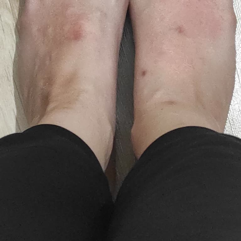 Gratis Ayak Maskesi Alerji Yaptı!