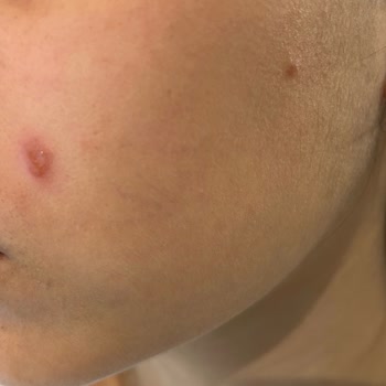 Tester Yüz Yıkama Jeli Sonrası Ciltte Ciddi Hasar