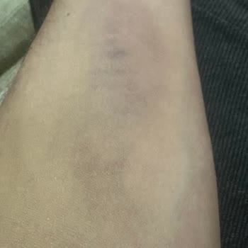 Yanlış Kan Alma İşlemi Sonrası Kolumda Morarmalar