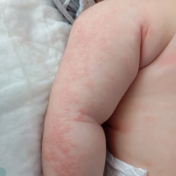 Bebeğimde Egzama Yapan Ürün