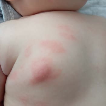 Bebeğimde Egzama Yapan Ürün