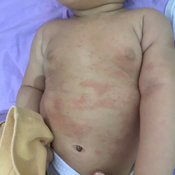 Dalin Ürünleri Nedeniyle Bebek Sağlığında Sorunlar Yaşadık