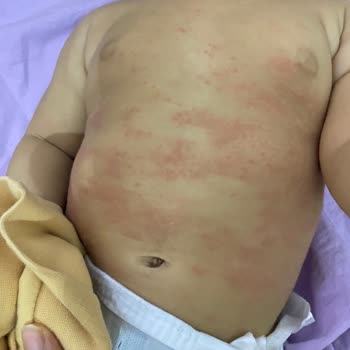 Dalin Ürünleri Nedeniyle Bebek Sağlığında Sorunlar Yaşadık