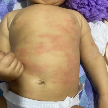 Dalin Ürünleri Nedeniyle Bebek Sağlığında Sorunlar Yaşadık