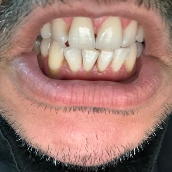 Sensodyne Diş Macunu Kullanımı Sonrası Yaşanan Sorunlar