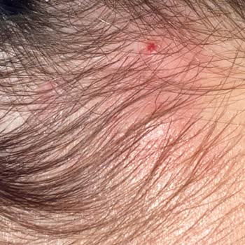 Urban Care Şampuanı Kullandıktan Sonra Yaşadığım Cilt Sorunları