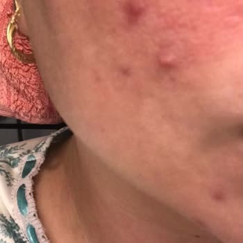 Neutrogena Güvendiğim Markanın Ürünü Cildimde Tahrişe Sebep Oldu