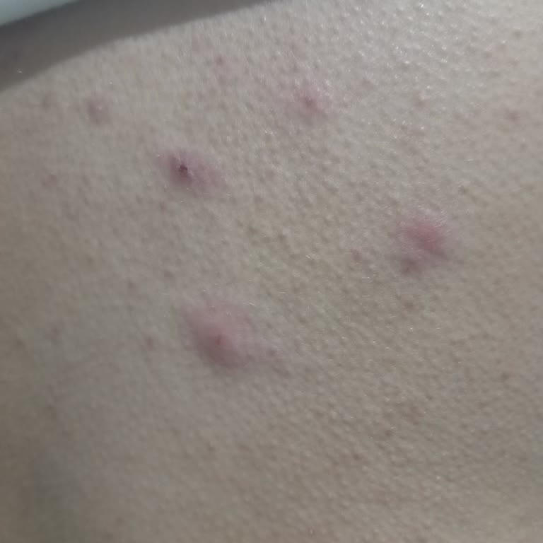 Filler Vegetal Krem Sonrası Ciltte Yanma Ve Dökülme Sorunu