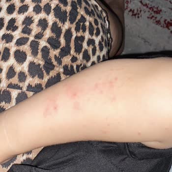 Baby Turco Bezleri Cilt Sorunlarına Yol Açıyor