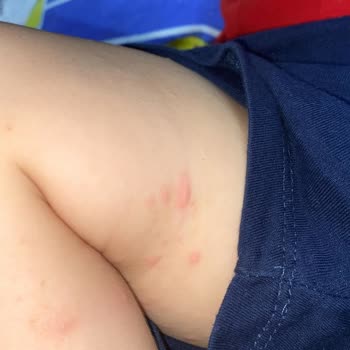 Baby Turco Bezleri Cilt Sorunlarına Yol Açıyor