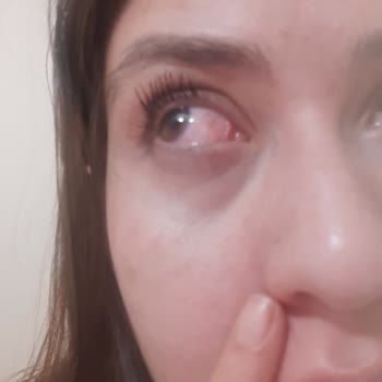 Trendyol Seller Kozmetik101 Sold Me a Fake Loreal Mascara That Infected My Eye