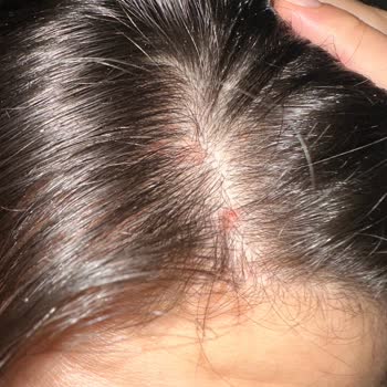 Yves Rocher Ürünleri Saç Dökülmesini Artırıyor Ve Yara Yapıyor