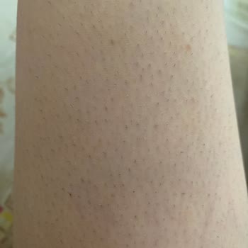 Yanıltıcı Fiyatlar Ve Etkisiz Lazer Tedavisi