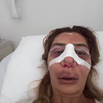 Estetik Ameliyatı Kabusu: H***** A**** Mağduriyeti