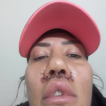 Estetik Ameliyatı Kabusu: H***** A**** Mağduriyeti