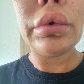 Estetik Ameliyatı Kabusu: H***** A**** Mağduriyeti