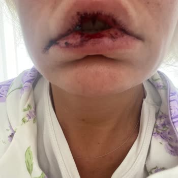 Estetik Ameliyatı Kabusu: H***** A**** Mağduriyeti