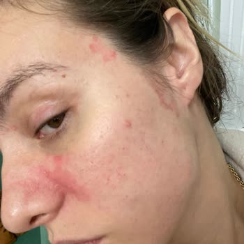 Alerjik Reaksiyon Yapan Ürünler